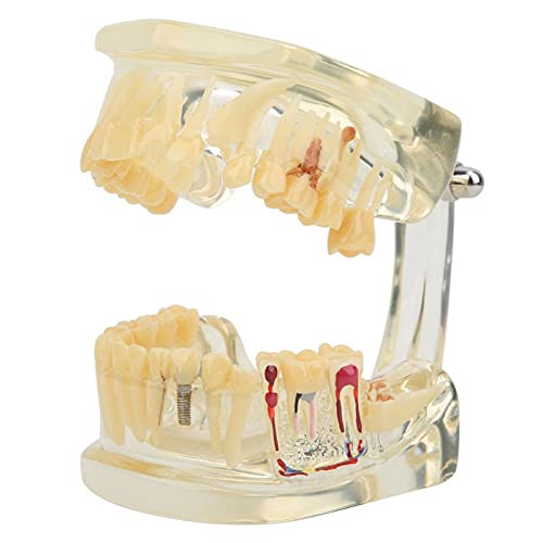 Diş Modeli-Yarım Patolojik Modeli Diş Öğretim Modeli için Diş Lab Hastane Araştırma, 3.5x2. 6x2. 4 in